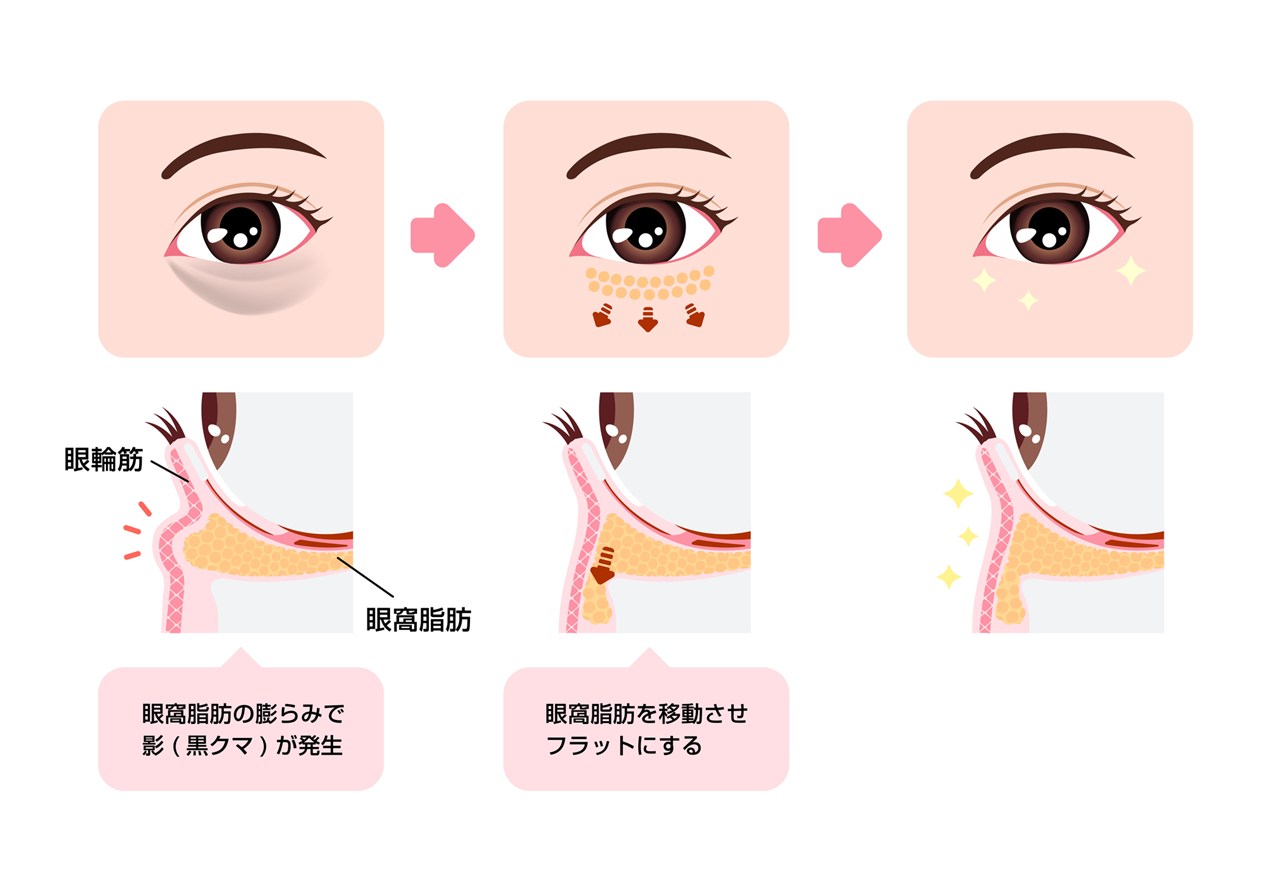 表ハムラ法の流れ
