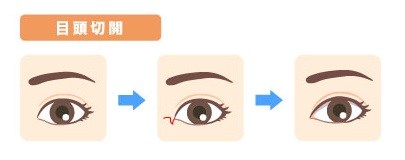 目頭切開とは