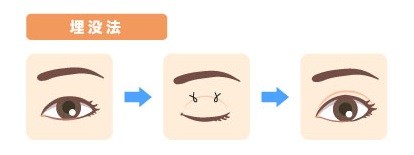 埋没法（まいぼつほう）とは