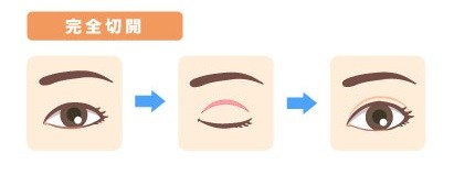 切開法の流れ