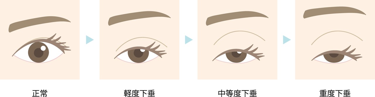 眼瞼下垂とは