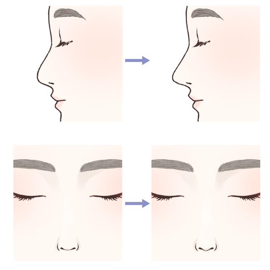 鼻尖形成とは
