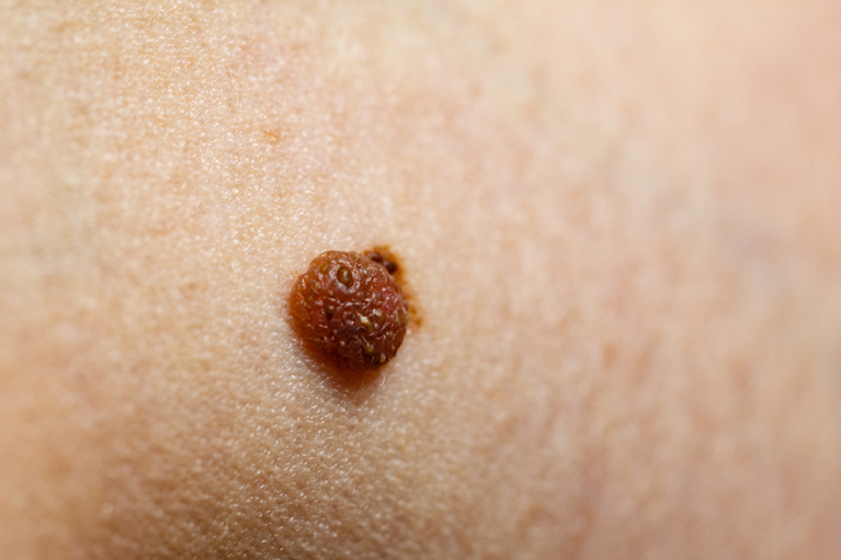 色素性母斑（ほくろ）