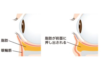 クマ・目の下のたるみの原因は3パターン